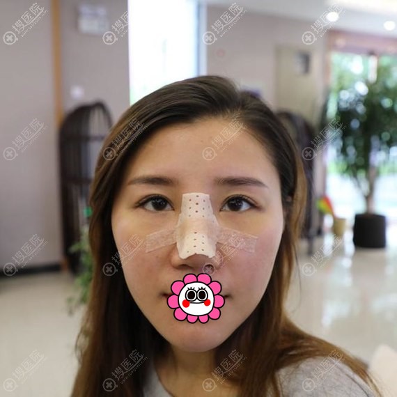昆山米扬丽格张金辉隆鼻术后5天 昆山米扬丽格张金辉隆鼻术后5天