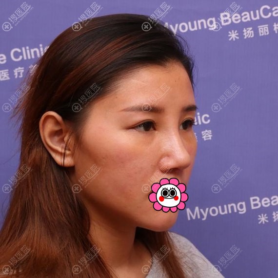 张金辉假体隆鼻拆线后 张金辉假体隆鼻拆线后