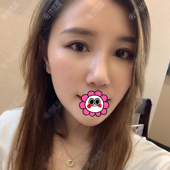 昆山米扬丽格张金辉假体隆鼻案例 昆山米扬丽格张金辉假体隆鼻案例