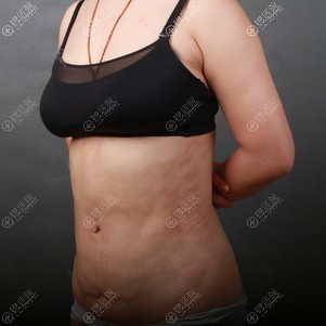 西安高一生陈伟腰腹吸脂后5天效果 西安高一生陈伟腰腹吸脂后5天效果