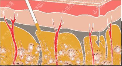 西安高一生吸脂效果怎么样 西安高一生吸脂效果怎么样