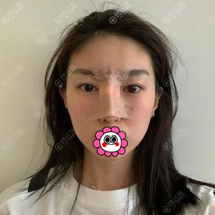 刘金华肋软骨隆鼻术后 刘金华肋软骨隆鼻术后