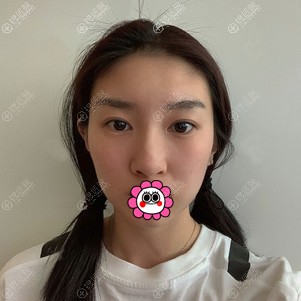 到郑州集美做肋软骨隆鼻前 到郑州集美做肋软骨隆鼻前