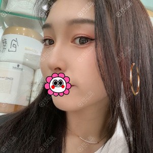 郑州集美肋软骨隆鼻恢复两个月 郑州集美肋软骨隆鼻恢复两个月