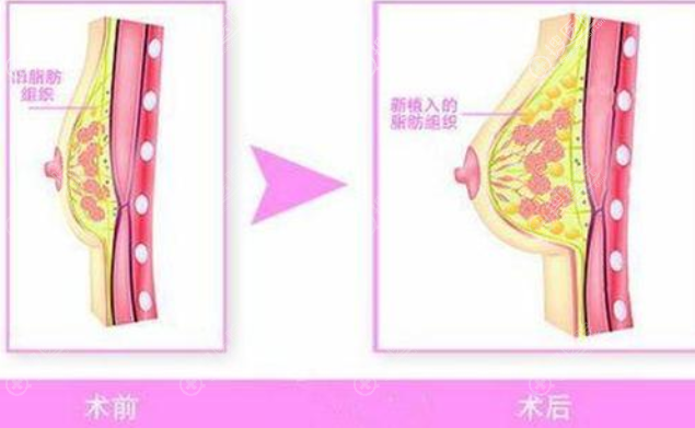 自体脂肪隆胸效果怎么样 自体脂肪隆胸效果怎么样