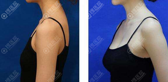 国产花样年华假体隆胸对比效果 国产花样年华假体隆胸对比效果