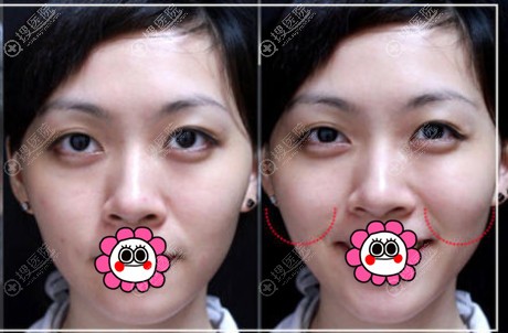 瑞蓝玻尿酸填充苹果肌效果对比图 瑞蓝玻尿酸填充苹果肌效果对比图