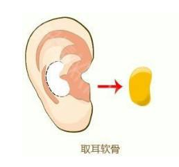 取耳软骨位置示意图 取耳软骨位置示意图