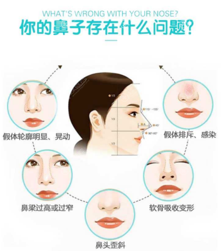 隆鼻失败类型 隆鼻失败类型
