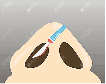 二次鼻修复建议选择肋软骨 二次鼻修复建议选择肋软骨