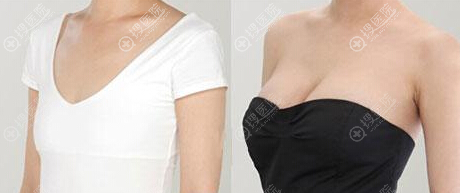 假体隆胸前后效果对比图 假体隆胸前后效果对比图