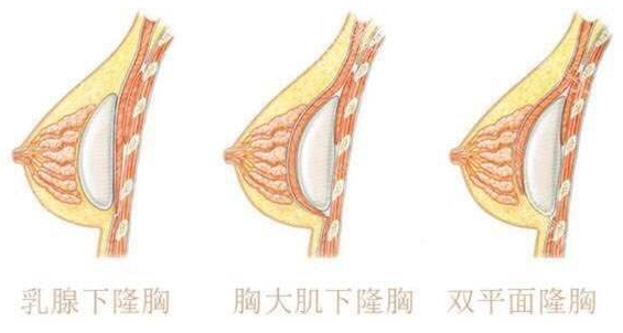 植入假体的方法 植入假体的方法