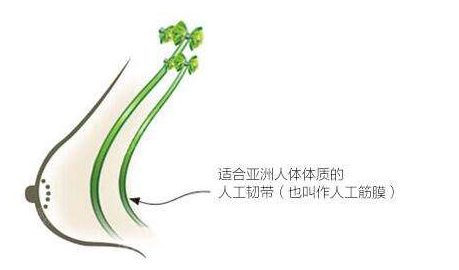 人工韧带乳房提升术 人工韧带乳房提升术