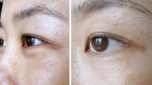 热玛吉眼周除皱效果 热玛吉眼周除皱效果