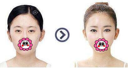 颧有手术前后对比效果 颧有手术前后对比效果