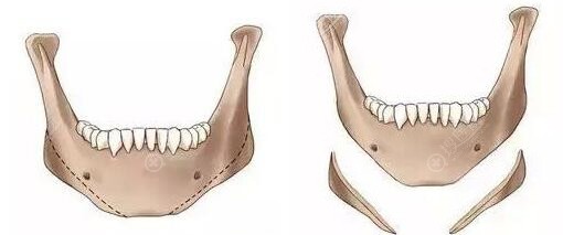 为什么下颌角十个做了九个后悔 为什么下颌角十个做了九个后悔