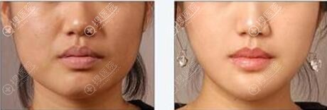 下颌角整形前后对比图 下颌角整形前后对比图