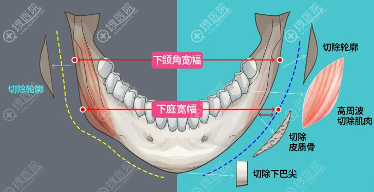下颌角整形示意图 下颌角整形示意图