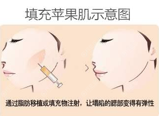 脂肪填充苹果肌示意图 脂肪填充苹果肌示意图