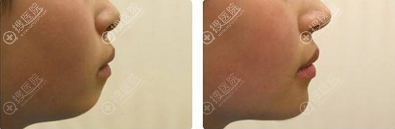 假体垫下巴对比效果图 假体垫下巴对比效果图