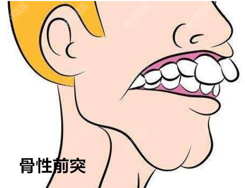 骨性龅牙怎么矫正? 骨性龅牙怎么矫正?