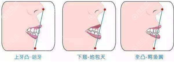 不同程度的骨性龅牙 不同程度的骨性龅牙