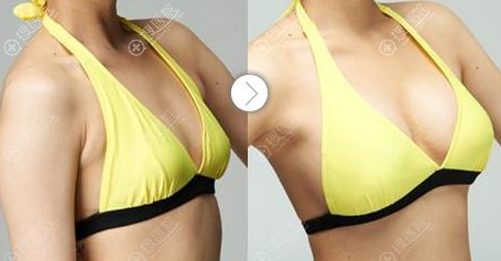 傲诺拉假体隆胸恢复半年对比效果图 傲诺拉假体隆胸恢复半年对比效果图