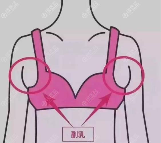 副乳不治疗会有什么影响? 副乳不治疗会有什么影响?