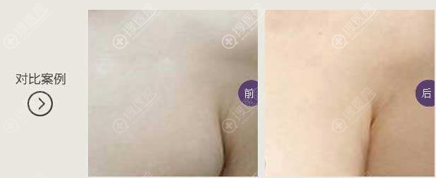 去除副乳前后对比效果 去除副乳前后对比效果
