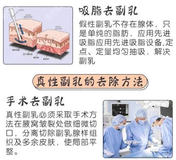 副乳的祛除方法 副乳的祛除方法