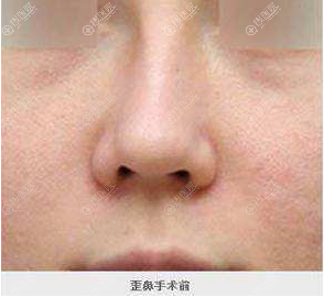 隆鼻20天后出现鼻子歪斜 隆鼻20天后出现鼻子歪斜