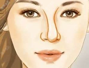 隆鼻后出现歪斜的原因有哪些? 隆鼻后出现歪斜的原因有哪些?