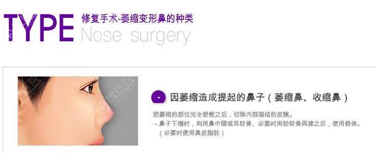 鼻尖萎缩怎么修复 鼻尖萎缩怎么修复