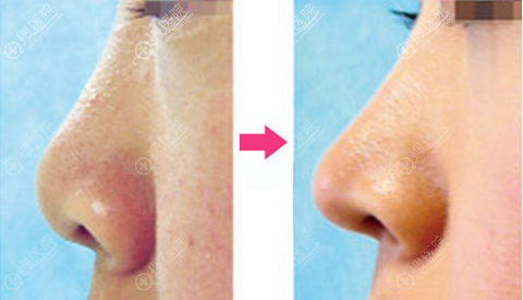 鼻头挛缩失败修复对比图 鼻头挛缩失败修复对比图