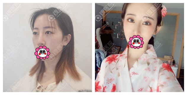 肋软骨隆鼻对比效果 肋软骨隆鼻对比效果