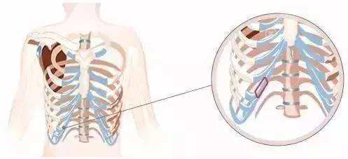 肋软骨隆鼻 肋软骨隆鼻