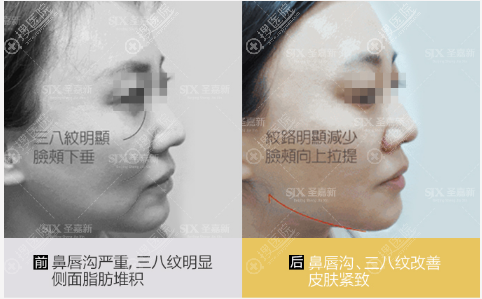 我来告诉你美容青春支架多少钱?它和埋线提升的区别是什么?