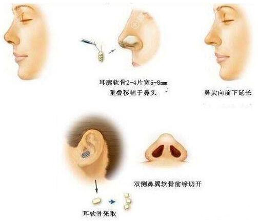 耳软骨隆鼻示意图 耳软骨隆鼻示意图