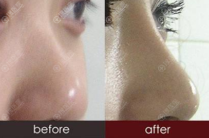 膨体隆鼻对比效果 膨体隆鼻对比效果