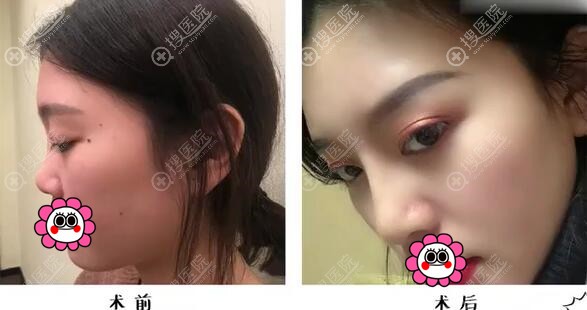 膨体加耳软骨隆鼻案例 膨体加耳软骨隆鼻案例