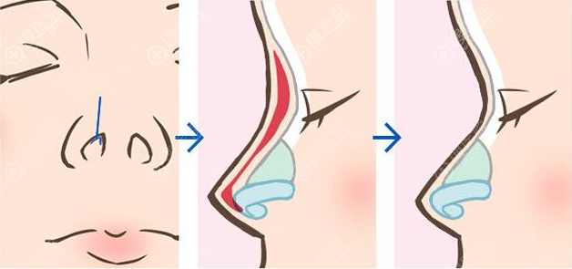 膨体+耳软骨隆鼻效果怎么样 膨体+耳软骨隆鼻效果怎么样