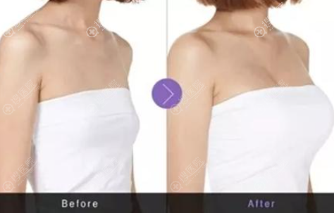 傲诺拉星熠隆胸效果 傲诺拉星熠隆胸效果