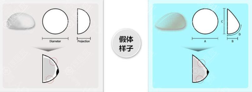 曼托假体隆胸型号 曼托假体隆胸型号