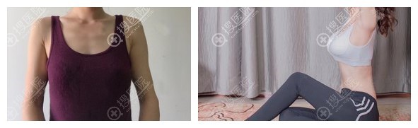 成都美绽美何一波隆胸案例 成都美绽美何一波隆胸案例