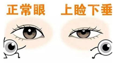 如果你分不清提肌无力和上睑下垂,看完区别后再找解决的办法