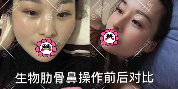 生物肋骨鼻案例 生物肋骨鼻案例