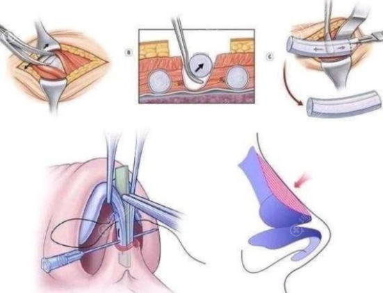 全肋软骨隆鼻示意图 全肋软骨隆鼻示意图