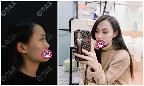 全肋软骨隆鼻案例 全肋软骨隆鼻案例