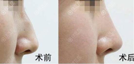 驼峰鼻矫正前后图片 驼峰鼻矫正前后图片