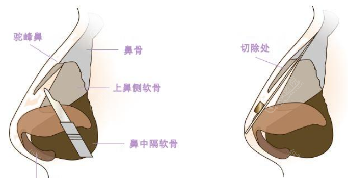驼峰鼻矫正示意图 驼峰鼻矫正示意图